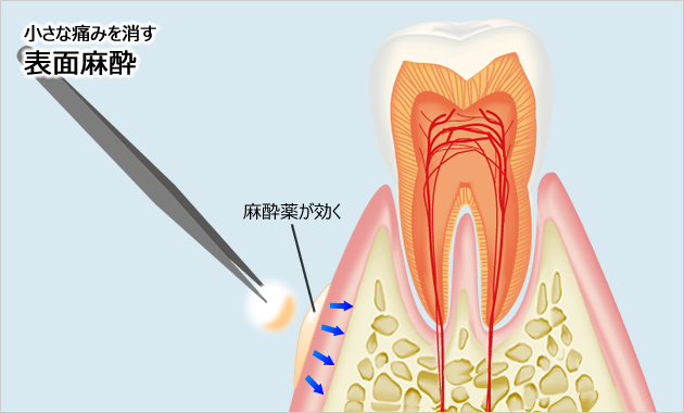 表面麻酔