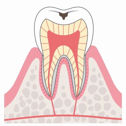 C1（エナメル質のむし歯）