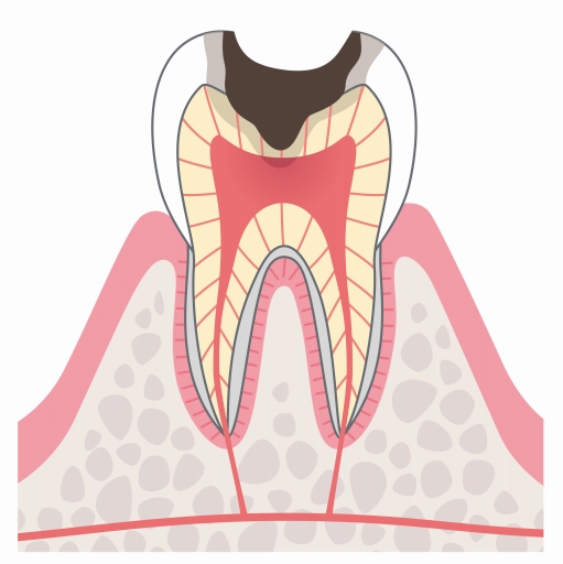C3（神経のむし歯）