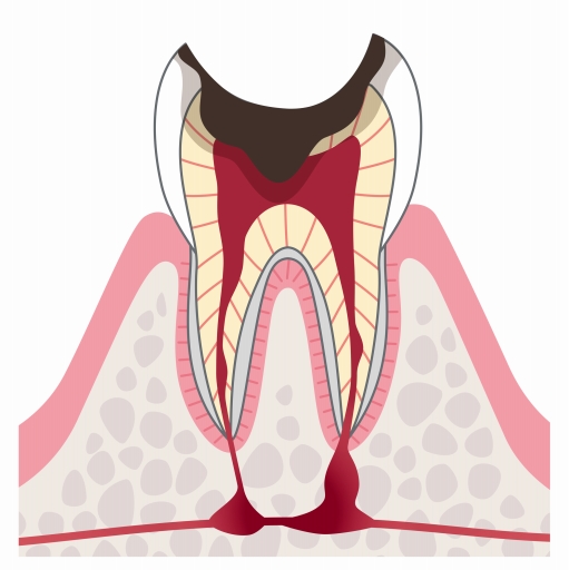 C4（歯根のむし歯）