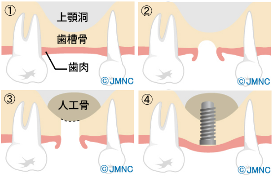 ソケットリフト法