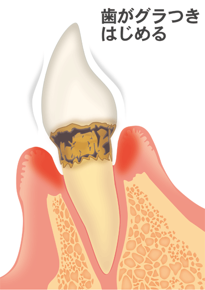 歯周病（中等度）