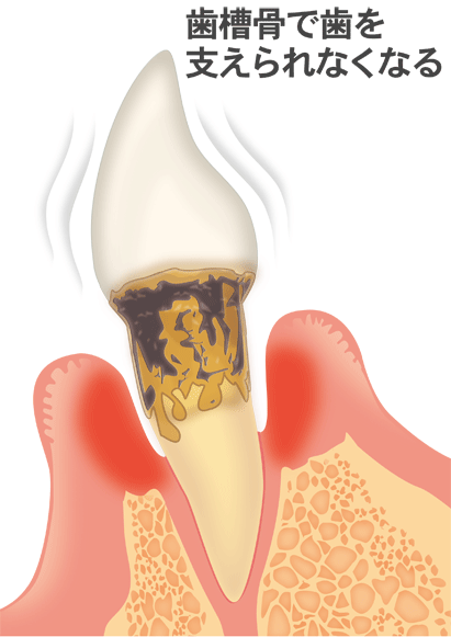 歯周病（重度）