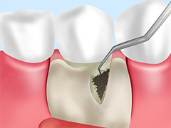 歯周外科治療