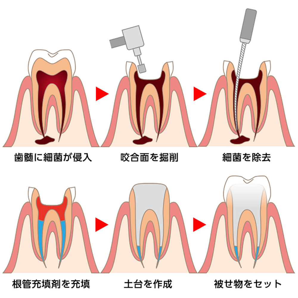 精密根管治療とは？